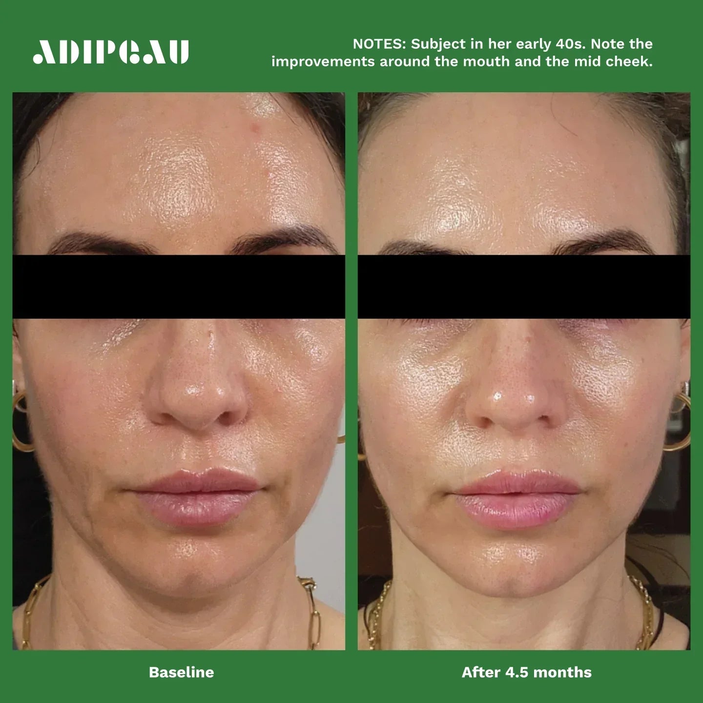 Discover how Adipeau’s patented Strength Gel and Volume Cream harness dermal fat-cell science to firm, tone and restore skin volume.