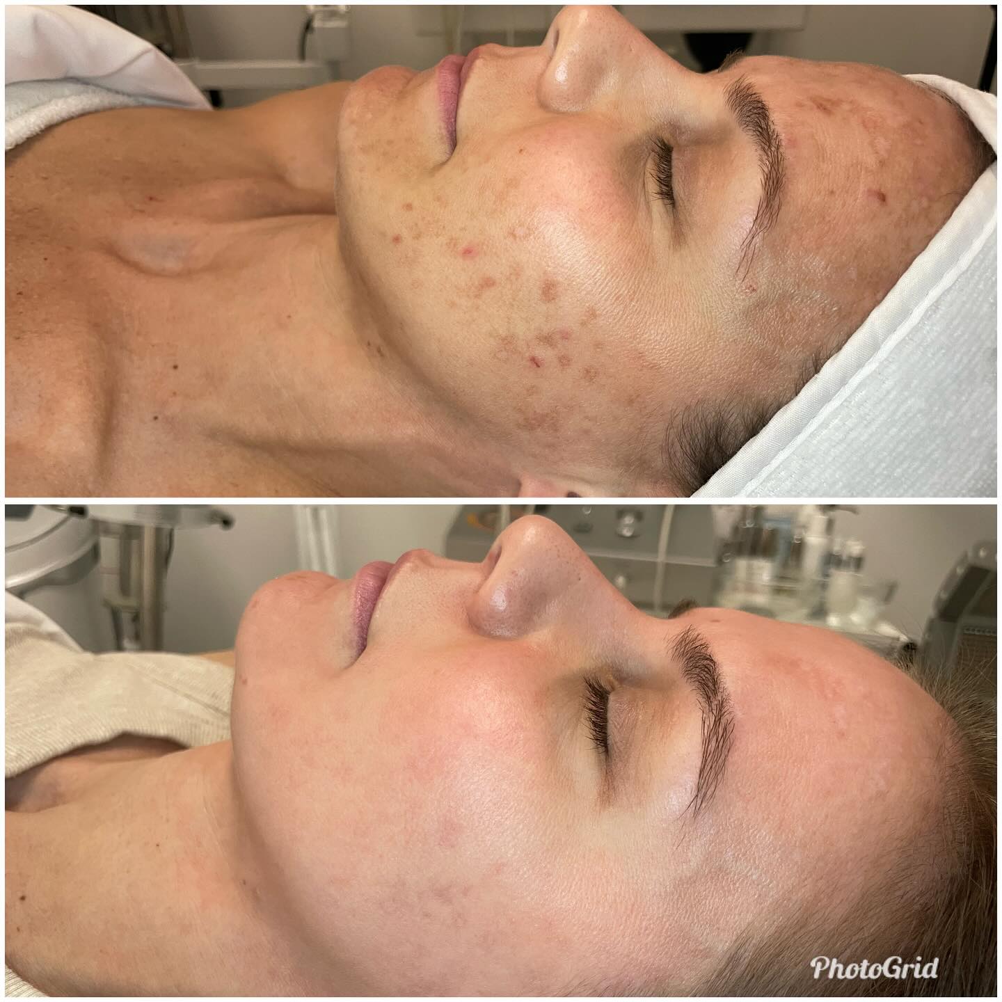 Cosmelan Peel Treatment for Hyperpigmentation & Melasma