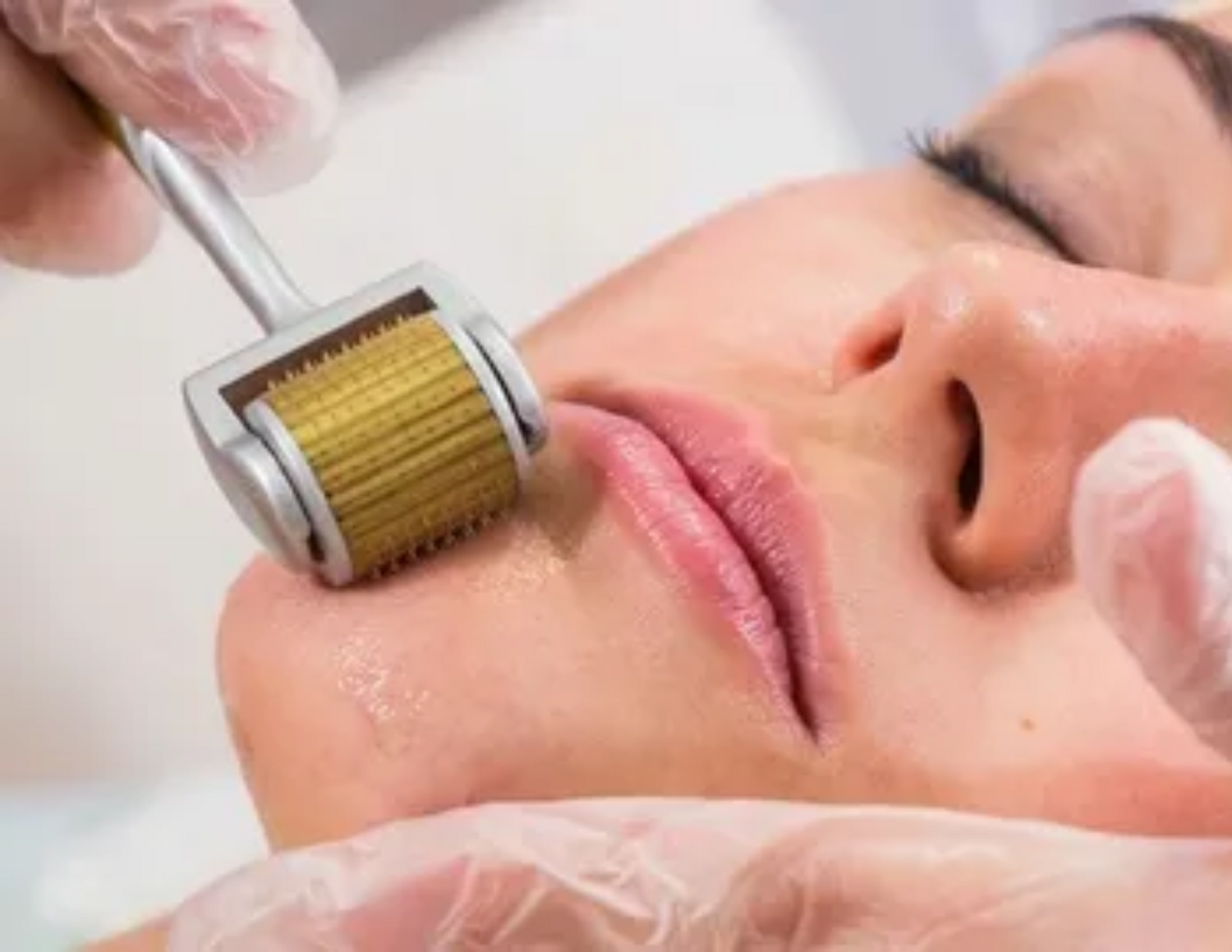 Microneedling in Boca Raton FL | Complete Guide to Microneedling