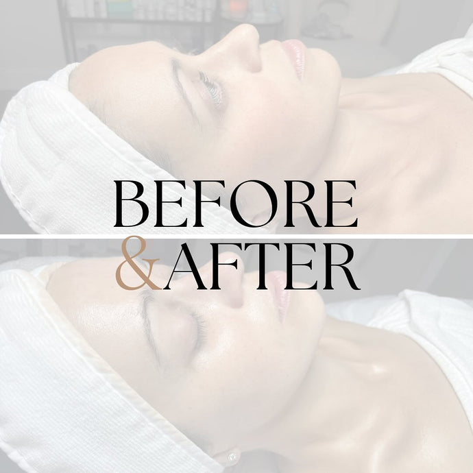 Facials Treatments in Boca Raton