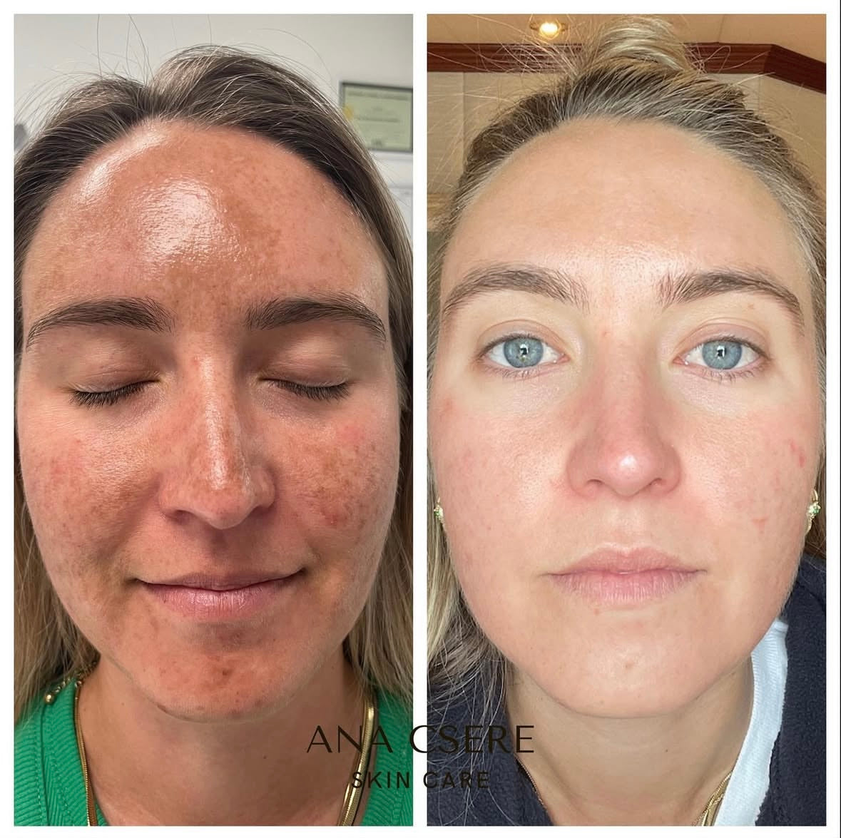 COSMELAN PEEL BEFORE AND AFTER